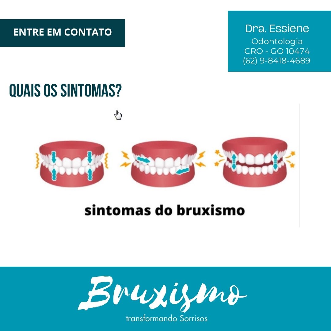 BRUXISMO EM GOIÂNIA TRATAMENTO Dra.Essiene
