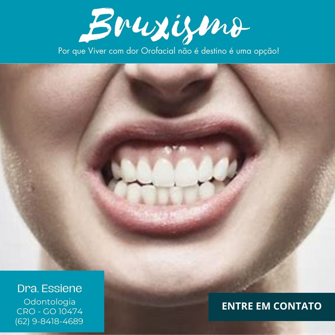 BRUXISMO EM GOIÂNIA TRATAMENTO Dra.Essiene